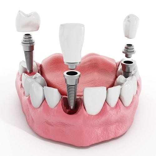 implant dentar targoviste