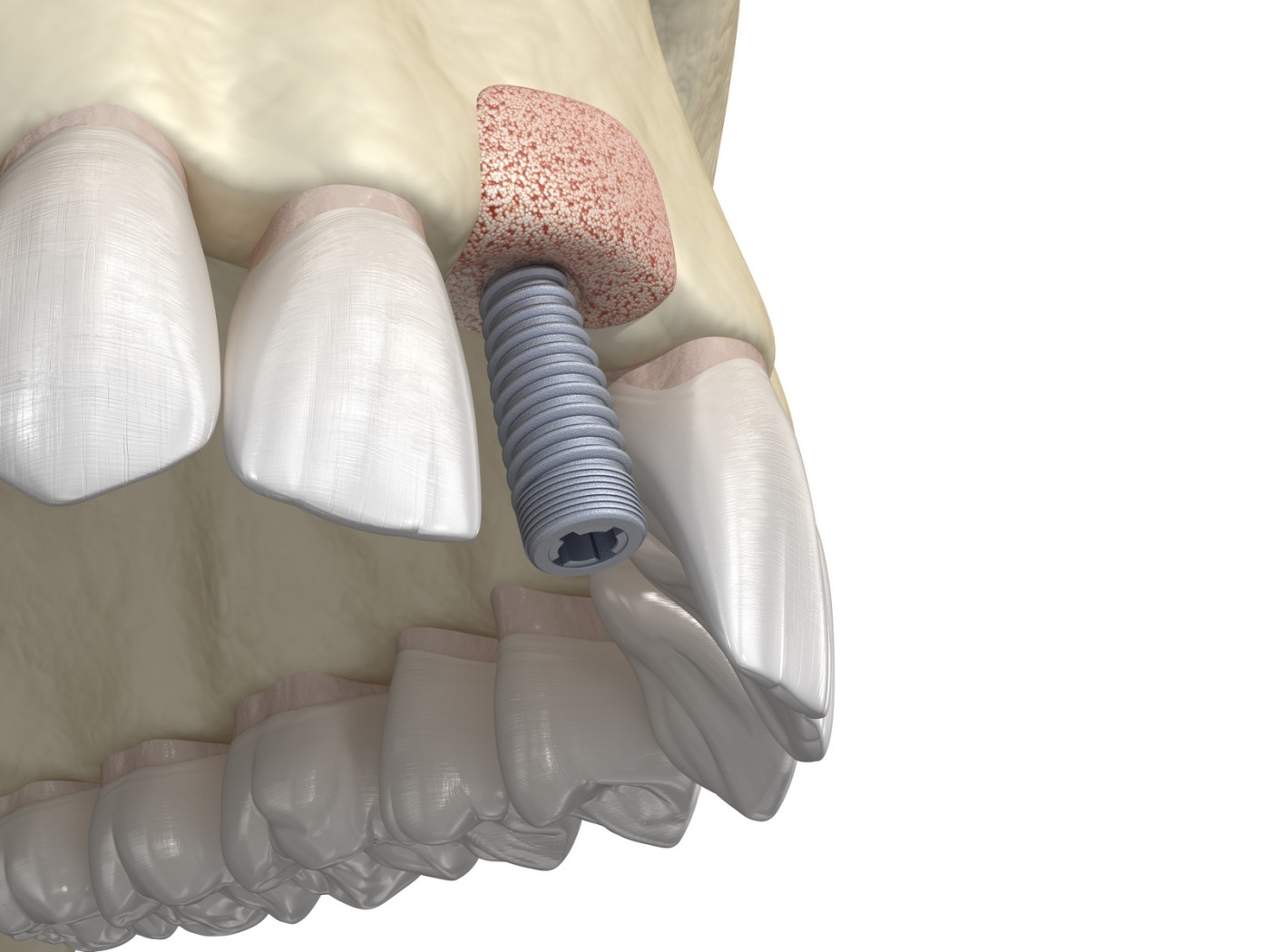 Adiție de os pentru implantul dentar